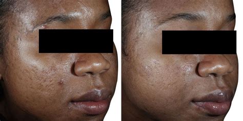Venus Viva™ Skin Resurfacing Acne Scar Treatment.